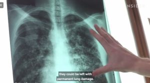 Primul transplant de plămân de porc la om: organul a funcționat timp de nouă zile, oferind speranțe în contextul deficitului global de organe și potențialului xenotransplantuluiea noastră”