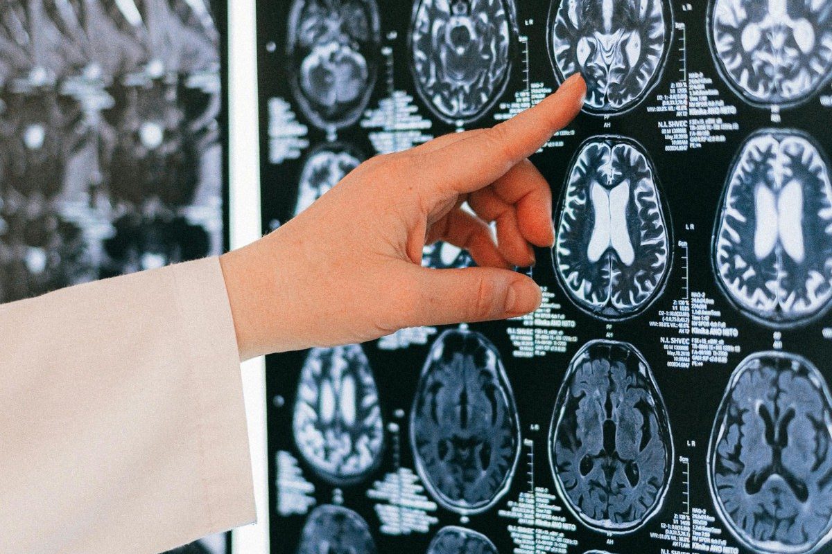 creier-harta-radiografie.jpg