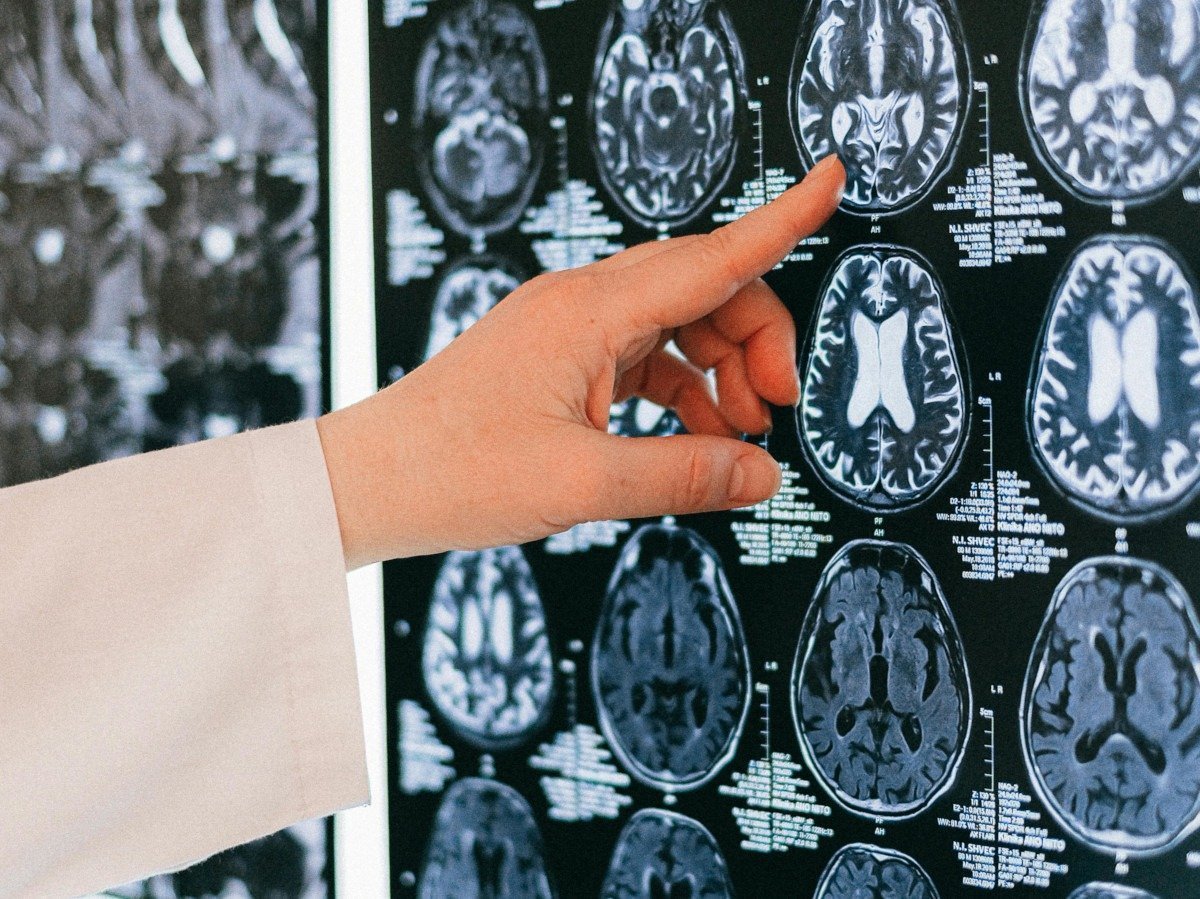 Dieta ketogenică, bogată în grăsimi și cu conținut redus de carbohidrați, poate susține sănătatea cerebrală și încetini deteriorarea funcțiilor cognitive