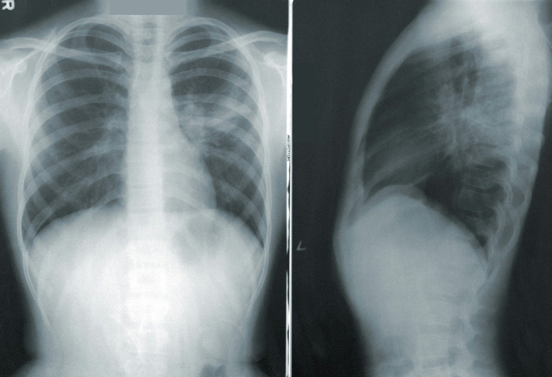 Tuberculoza, principala cauză de deces provocată de boli infecțioase la nivel global, a omorât 1,23 milioane de oameni în 2024, conform Organizației Mondiale a Sănătății