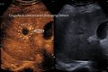 ecografie-tumoare.jpg