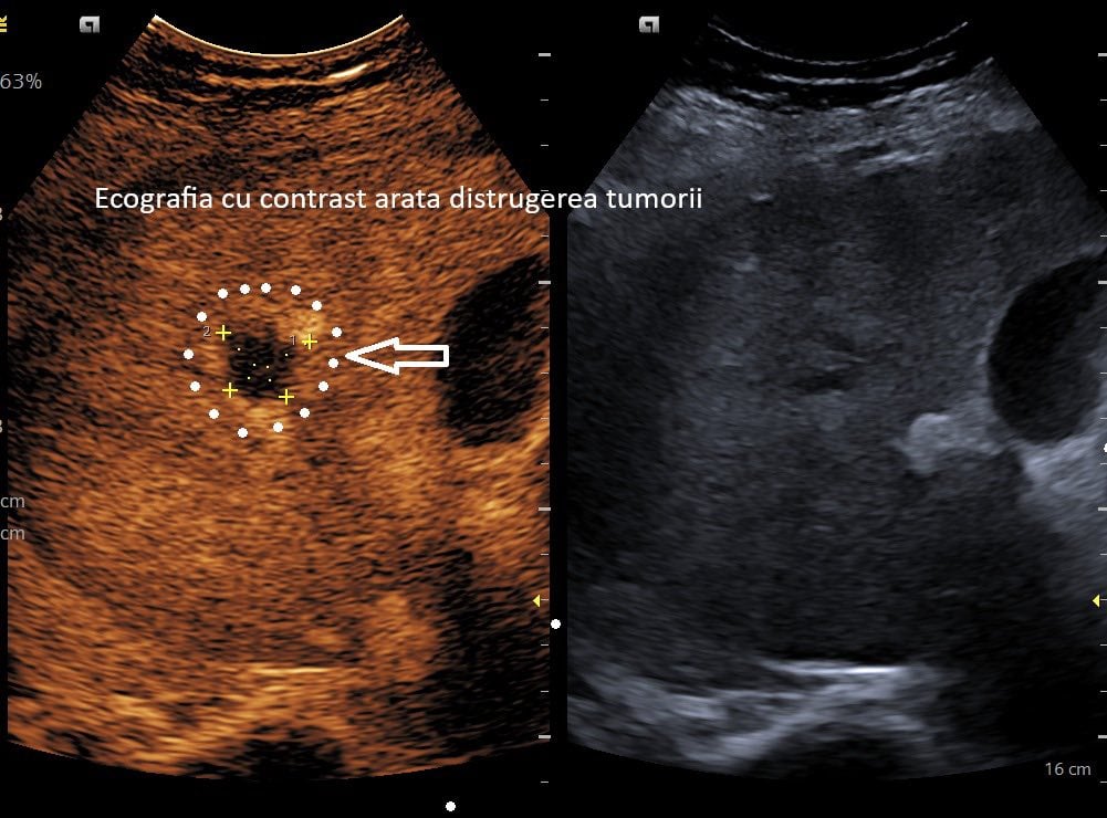 ecografie-tumoare.jpg