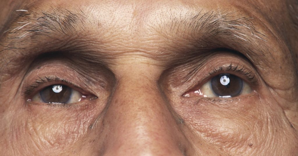 O bacterie prezentă în ochi, asociată cu boala Alzheimer și declinul cognitiv, arată un nou studiu