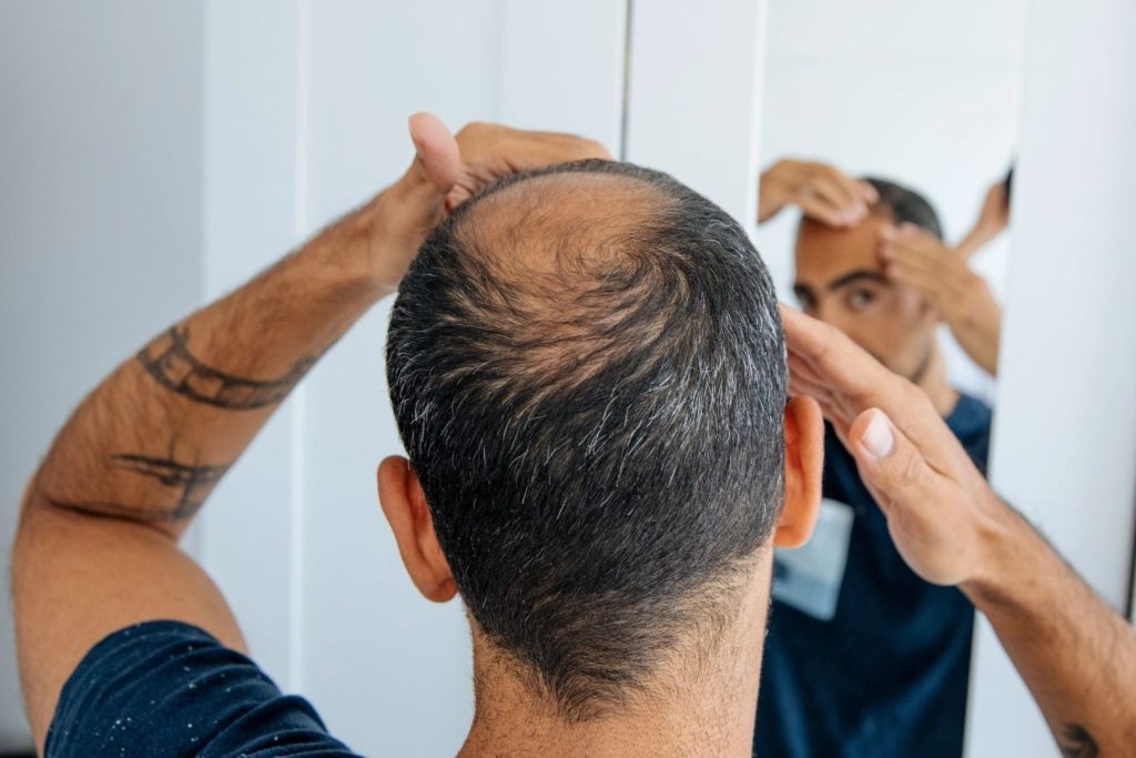 Oamenii de știință au reușit să creeze în laborator foliculi de păr funcționali, dar un tratament pentru alopecie este încă departe O echipă de cercetători a făcut un pas important în domeniul medicinei regenerative, reușind să creeze în laborator foliculi de păr care pot genera fire de păr și pot trece prin ciclul normal de creștere și cădere