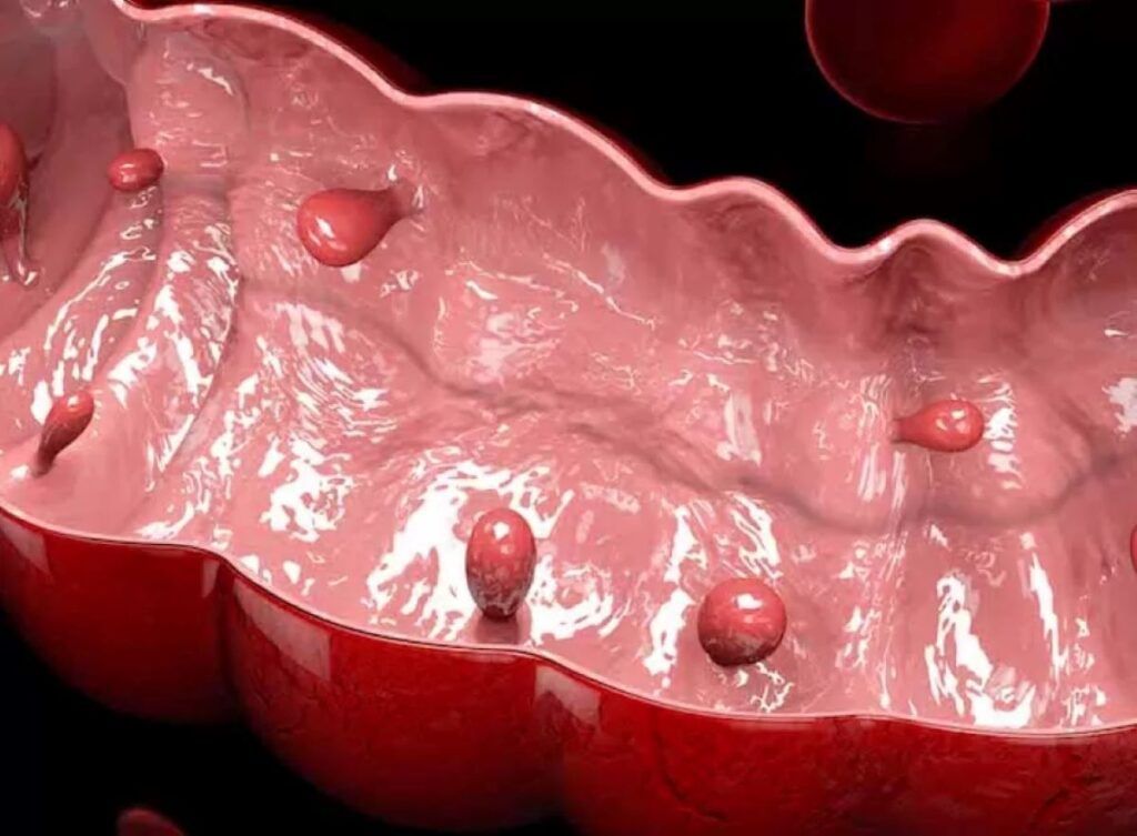 Polipii sesili: Semnale silențioase ale pericolului în intestinul gros În lumea medicală, anumite afecțiuni rămân adesea ascunse, dezvoltându-se în tăcere până când se manifestă în moduri mai serioase