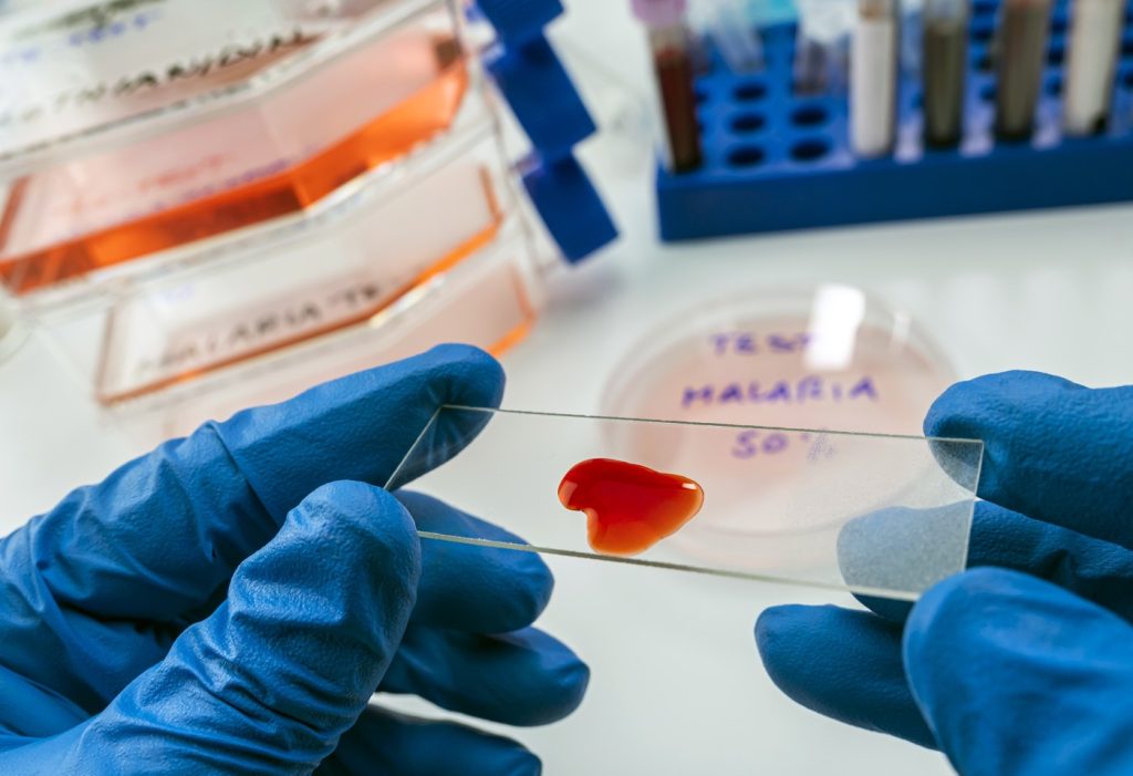 Trei copii din Iași, suspectați de malarie, se află sub supraveghere medicală Ministerul Sănătății a raportat confirmarea a trei cazuri suspecte de malarie la minori în cursul zilei de astăzi, 23 martie
