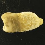 Bacterie de scarlatină, găsită într-o mumie! Descoperirea uluitoare schimbă istoria