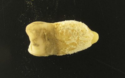 Bacterie de scarlatină, găsită într-o mumie! Descoperirea uluitoare schimbă istoria