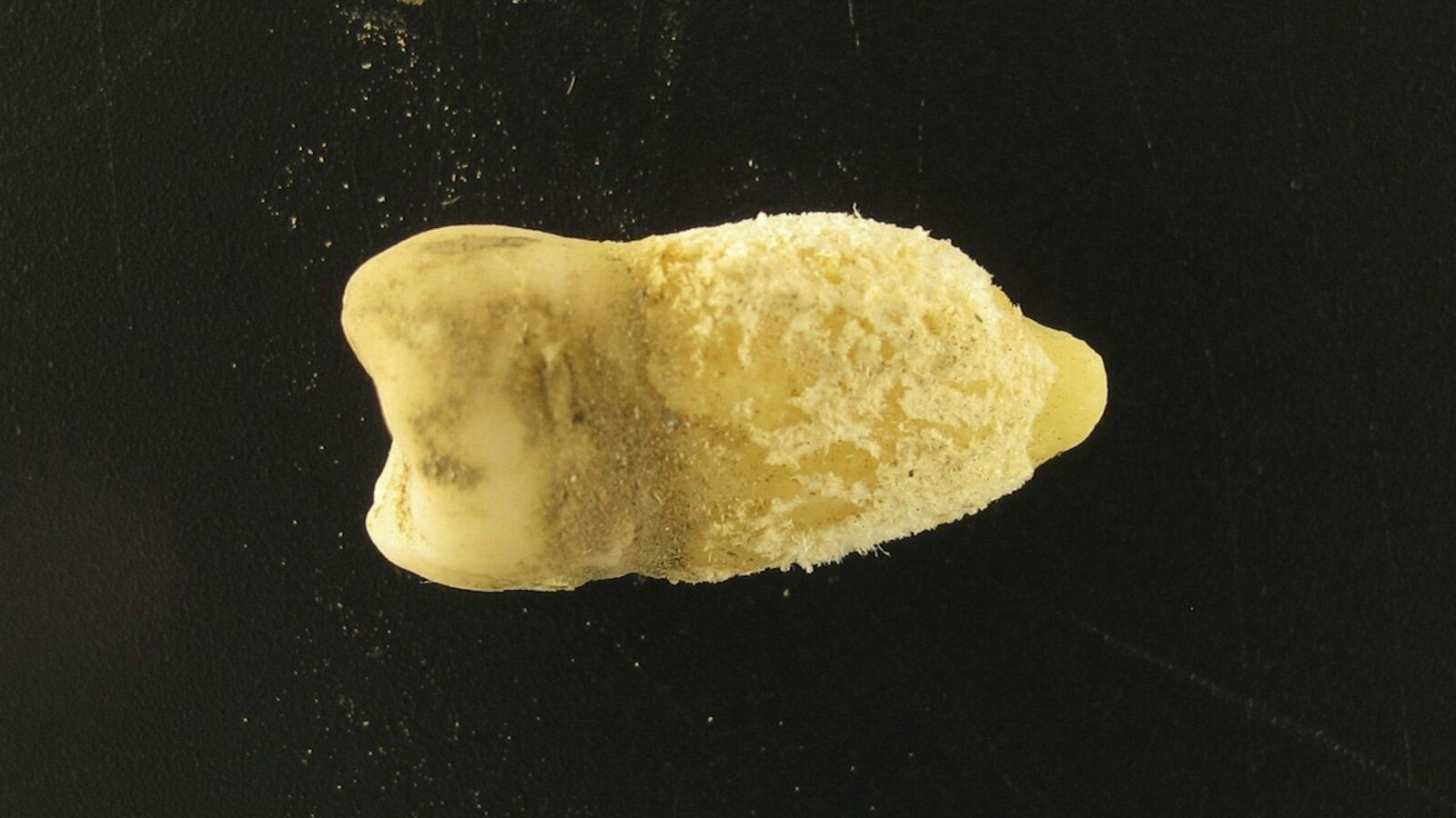 Bacterie de scarlatină, găsită într-o mumie! Descoperirea uluitoare schimbă istoria