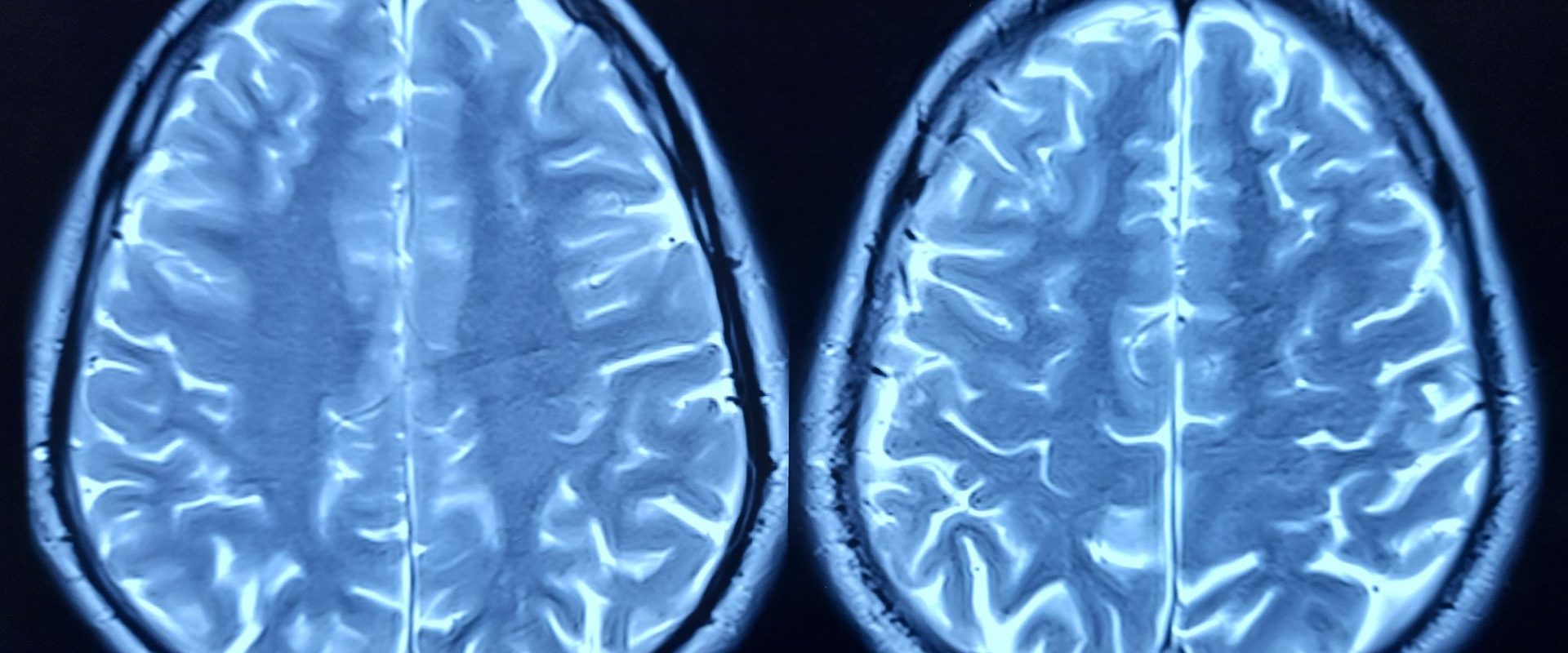 Oamenii de știință au dat verdictul: Ce grăbește îmbătrânirea creierului