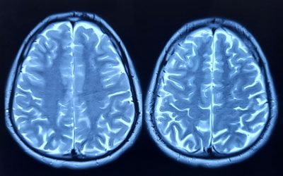 Oamenii de știință au dat verdictul: Ce grăbește îmbătrânirea creierului