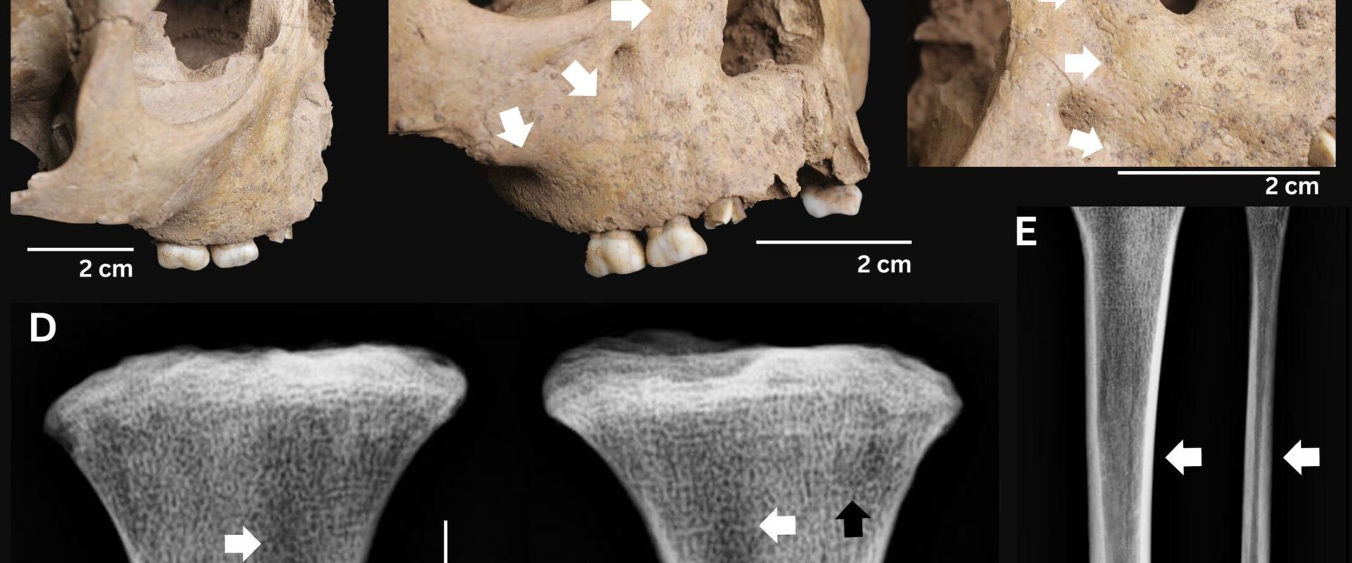 Dinții copiilor antici: Boala fatală care terifia acum 4000 de ani