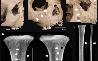 Dinții copiilor antici: Boala fatală care terifia acum 4000 de ani