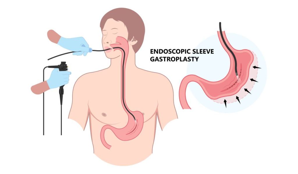 EȘEC? Endoscopie anti-obezitate: Alternativă fără bisturiu la micșorarea de stomac