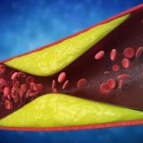 Șapte semne de artere blocate: Ce ignoră pacienții, spun cardiologii