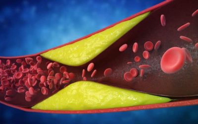 Șapte semne de artere blocate: Ce ignoră pacienții, spun cardiologii