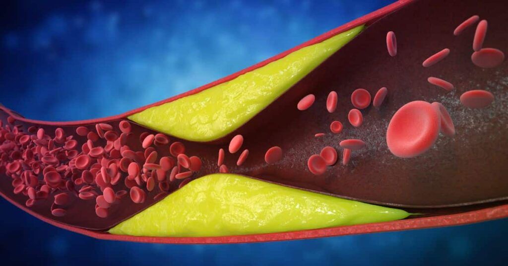 Șapte semne de artere blocate: Ce ignoră pacienții, spun cardiologii