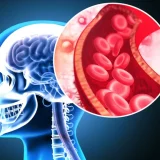 Grupă de sânge, factor de risc MAJOR pentru AVC înainte de 60 de ani