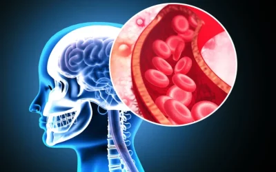 Grupă de sânge, factor de risc MAJOR pentru AVC înainte de 60 de ani