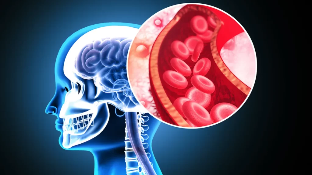Grupă de sânge, factor de risc MAJOR pentru AVC înainte de 60 de ani
