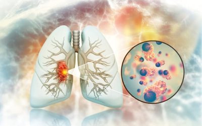 Crește alarmant cancerul pulmonar la nefumători. Medici, perplecși de cauze