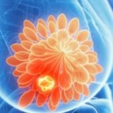 Factori cruciali în recuperarea după cancerul de sân. Sfaturile experților