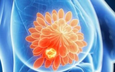 Factori cruciali în recuperarea după cancerul de sân. Sfaturile experților