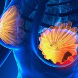 Semnele CANCERULUI la sân: 5 simptome la care să fii atentă!