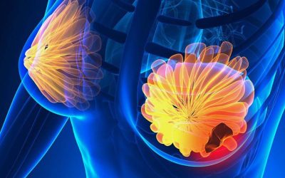 Semnele CANCERULUI la sân: 5 simptome la care să fii atentă!