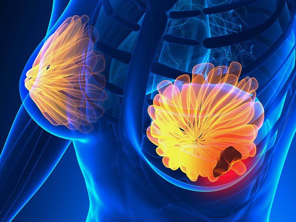 Semnele CANCERULUI la sân: 5 simptome la care să fii atentă!