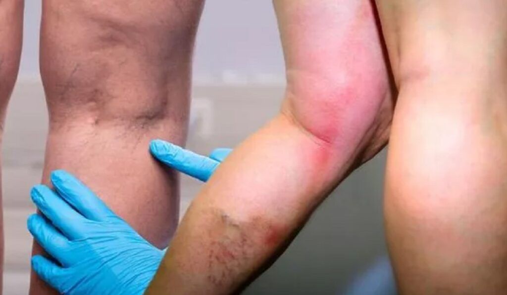 Vitamina salvatoare: Previne cheagurile și întărește imunitatea