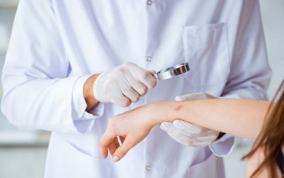 Ectima: Cauze și tratament. Află cum te protejezi de infecție