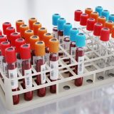 Analiză de sânge revoluționară: Prevestește infarctul mai bine decât colesterolul