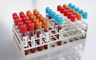 Analiză de sânge revoluționară: Prevestește infarctul mai bine decât colesterolul