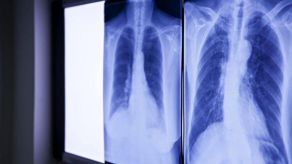 Medici, șocați de ce au găsit în abdomenul unui bărbat: „E de 20 ani acolo”