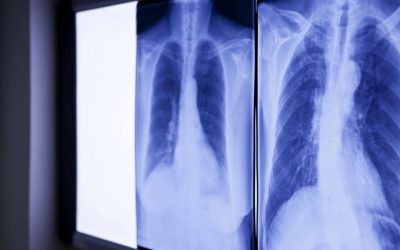 Medici, șocați de ce au găsit în abdomenul unui bărbat: „E de 20 ani acolo”