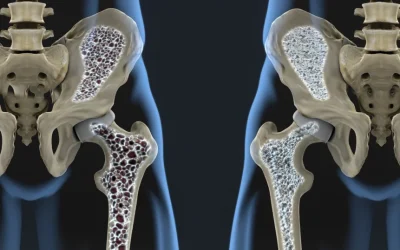 Nou tratament promite oase mai puternice: Adio, osteoporoză!