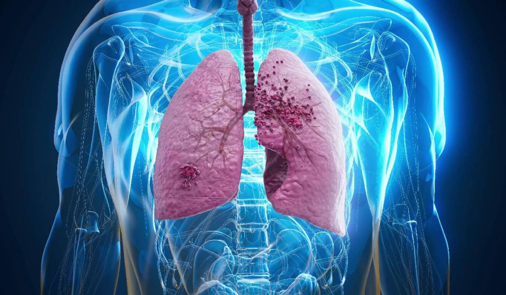 Cancerul pulmonar, o boală cu un impact devastator la nivel global, continuă să ridice semne de întrebare și să alimenteze o serie de mituri