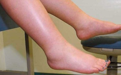 Leguma-minune: Scapă de retenția de apă și revitalizează circulația!