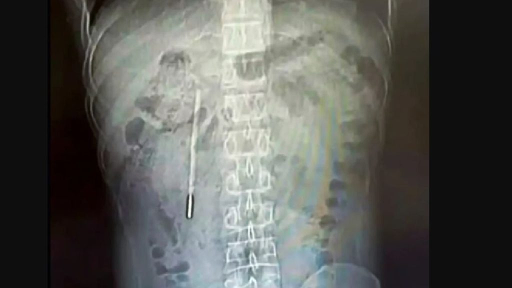 Medici șocați! Ce au găsit în stomacul unui bărbat din China, după 20 de ani