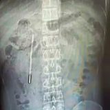 Medici șocați! Ce au găsit în stomacul unui bărbat din China, după 20 de ani