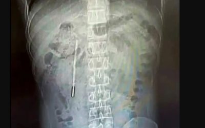 Medici șocați! Ce au găsit în stomacul unui bărbat din China, după 20 de ani