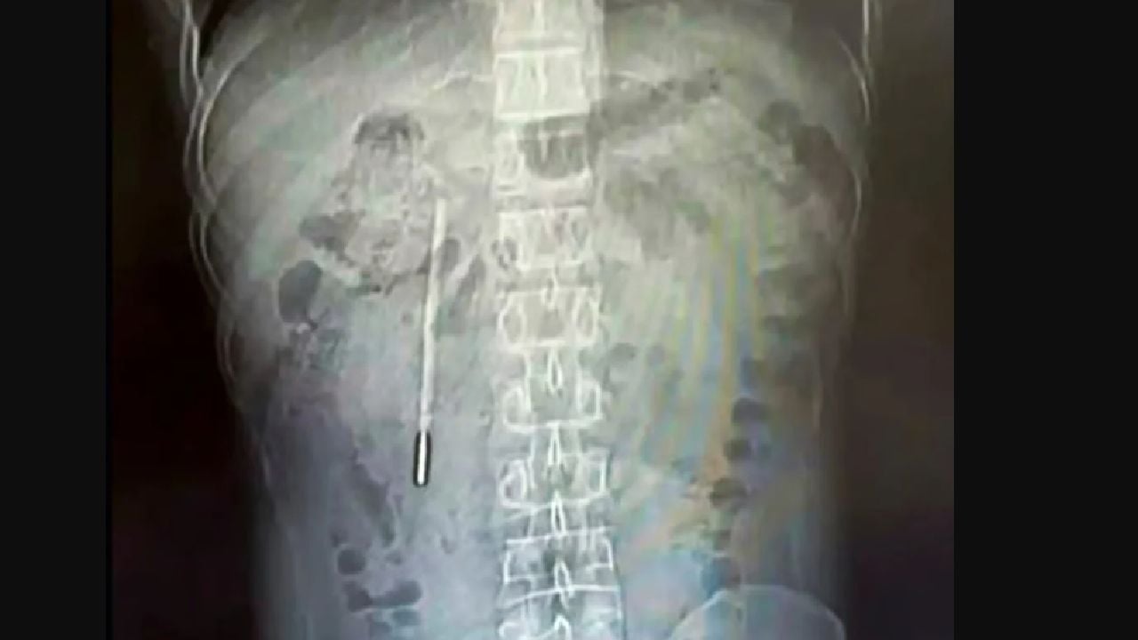 Medici șocați! Ce au găsit în stomacul unui bărbat din China, după 20 de ani