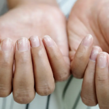 Unghiile Terry, semnul ascuns al bolilor grave: Ce trebuie să știi