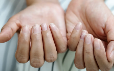 Unghiile Terry, semnul ascuns al bolilor grave: Ce trebuie să știi