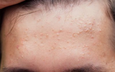 A scăpat de acnee în 3 pași? Acidul salicilic, arma secretă