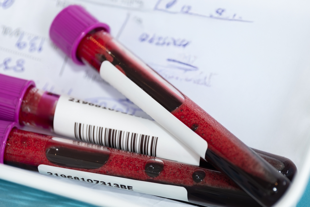Analizele care arată dacă diabetul a afectat rinichii: Ce trebuie să știi