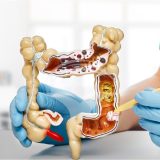 Cancer colon: Semnalul roșu pe care medicul îl atrage atenția