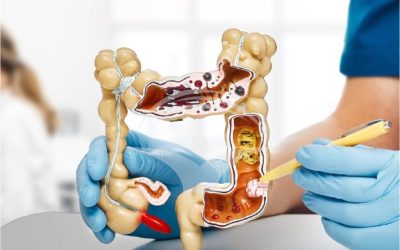 Cancer colon: Semnalul roșu pe care medicul îl atrage atenția