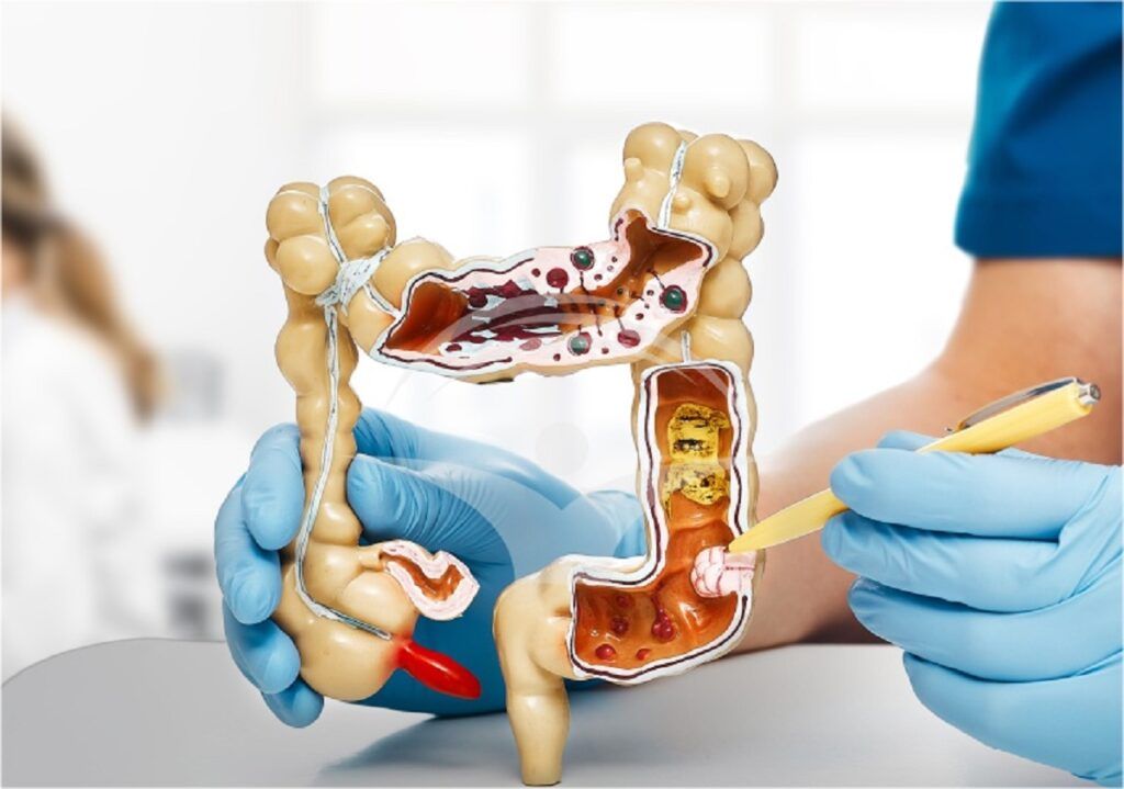 Cancer colon: Semnalul roșu pe care medicul îl atrage atenția